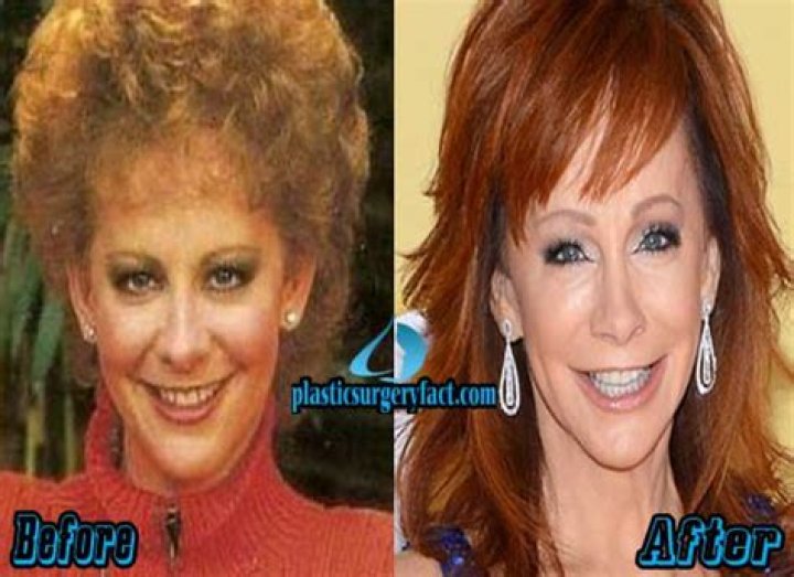 Reba Mcentire | Plastic Surgery | Before And After